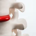 ヘルニア